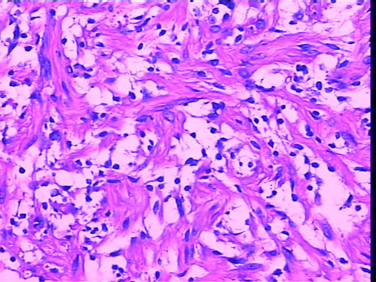 腹壁一个包块，巨检长相很似神经鞘瘤，不知是什么东东图6