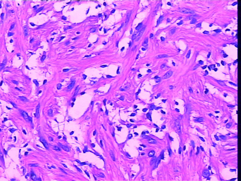 腹壁一个包块，巨检长相很似神经鞘瘤，不知是什么东东图7