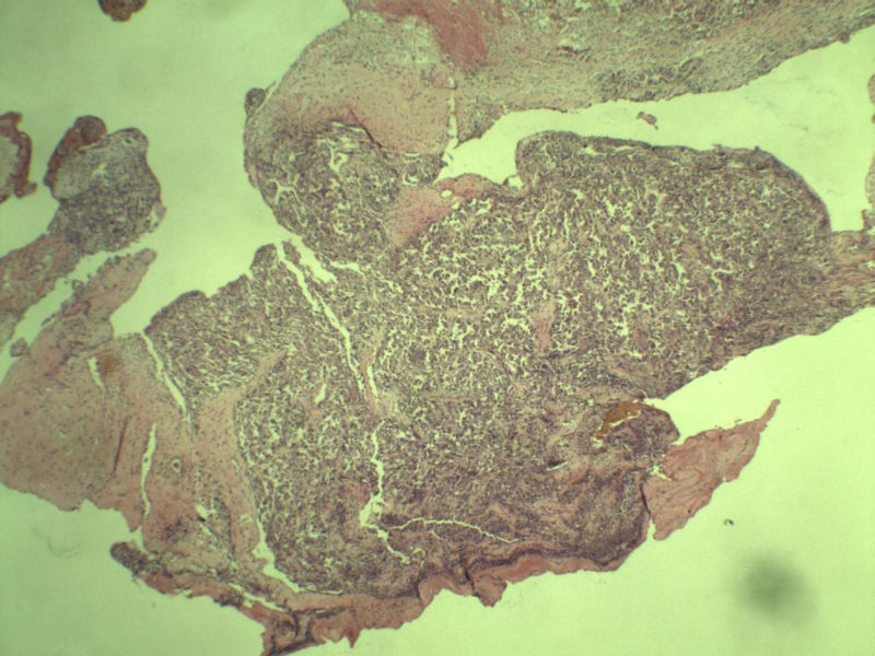 多发皮下结节图1