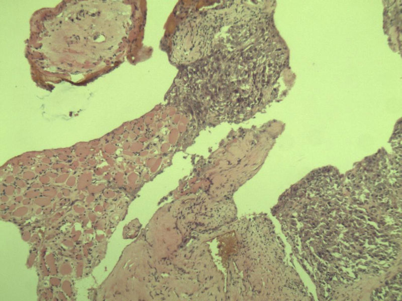 多发皮下结节图3