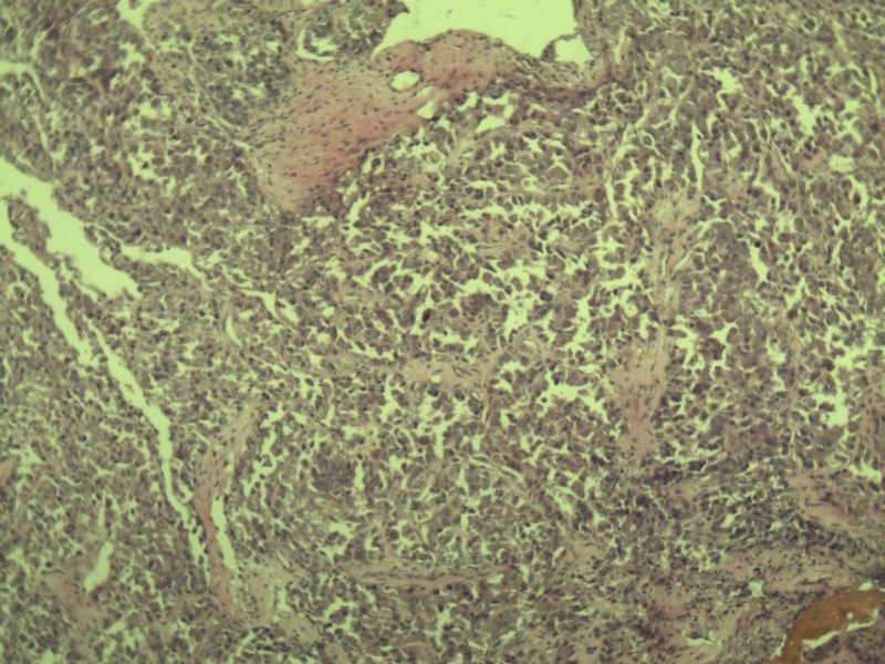 多发皮下结节图4