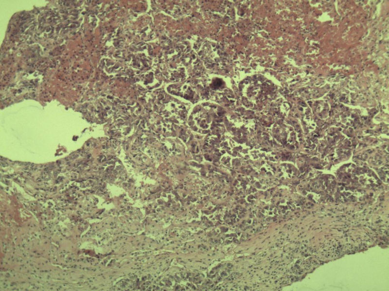 多发皮下结节图5