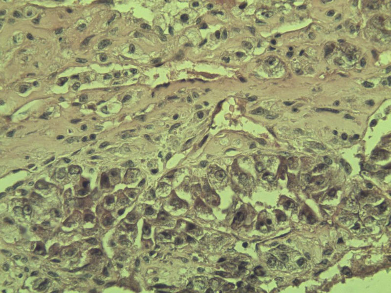 多发皮下结节图7