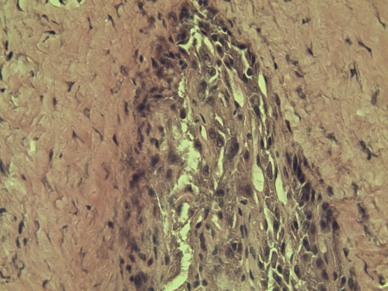 多发皮下结节图8