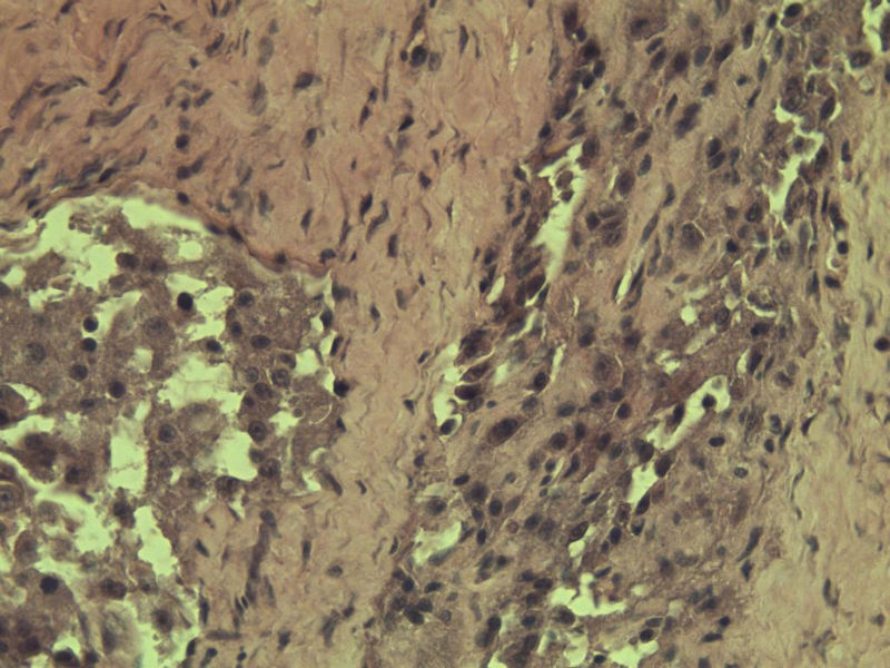 多发皮下结节图9