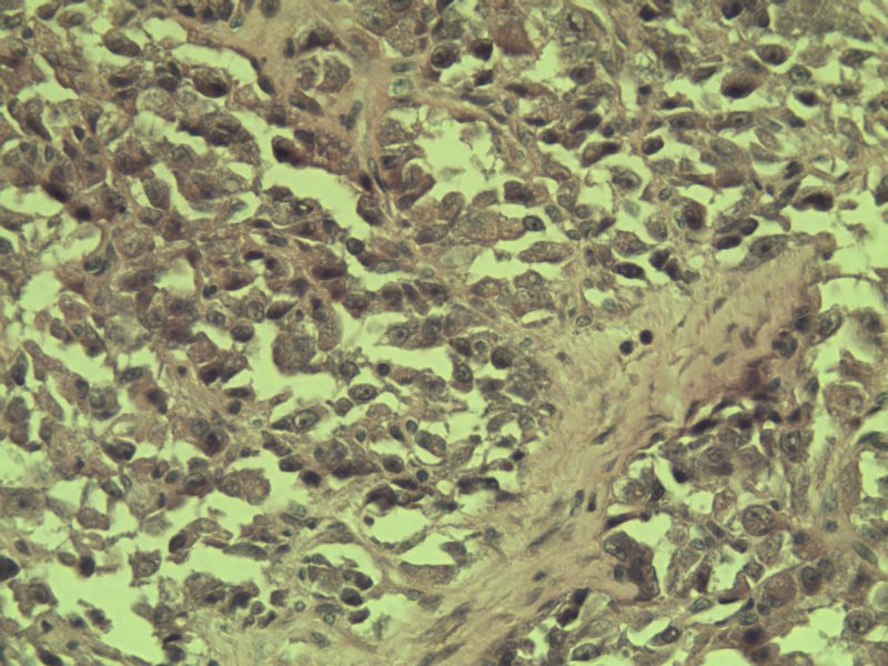 多发皮下结节图11