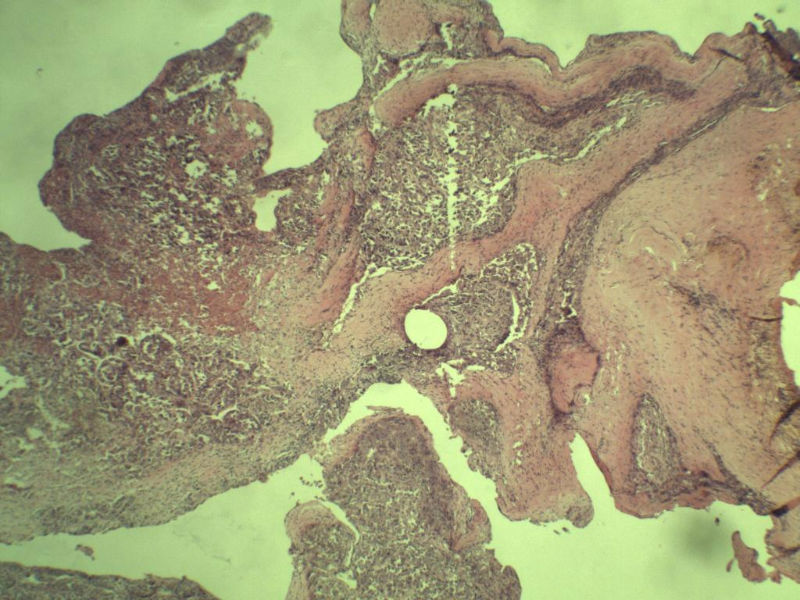 多发皮下结节图13