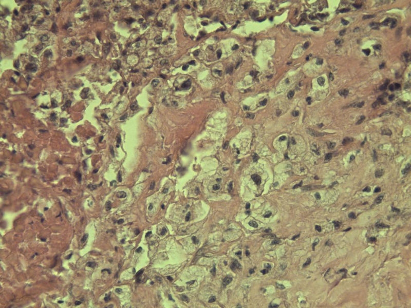 多发皮下结节图14