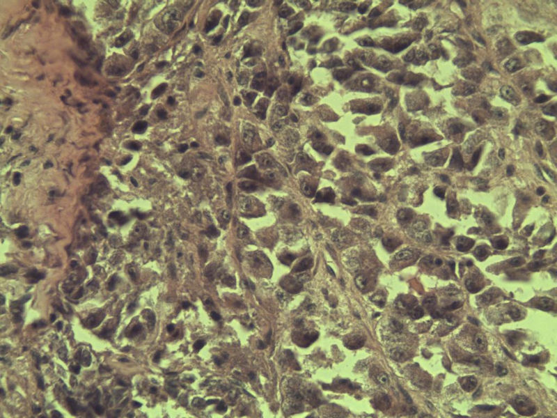 多发皮下结节图15