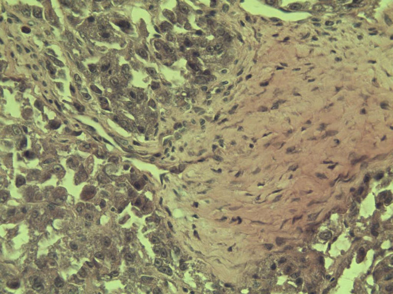 多发皮下结节图17