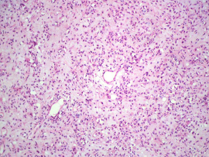 右股骨上段皮下肿物,新加免疫组化图10 右股骨上段皮下肿物,新加免疫组化图10