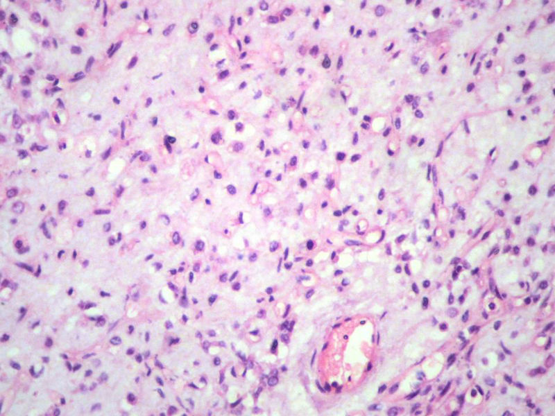 右股骨上段皮下肿物,新加免疫组化图12 右股骨上段皮下肿物,新加免疫组化图12