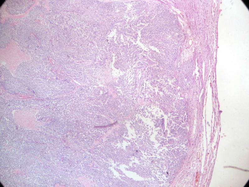 脑左颞部占位图1