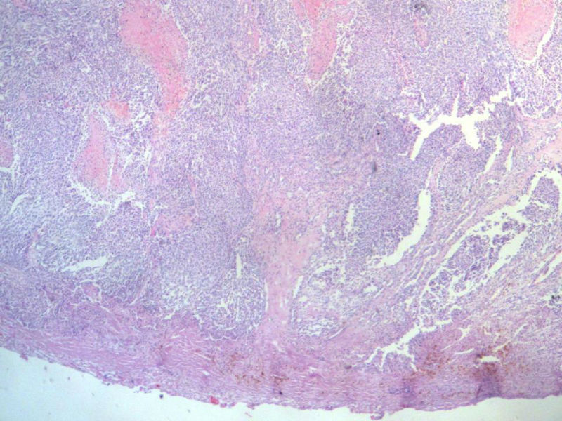 脑左颞部占位图2