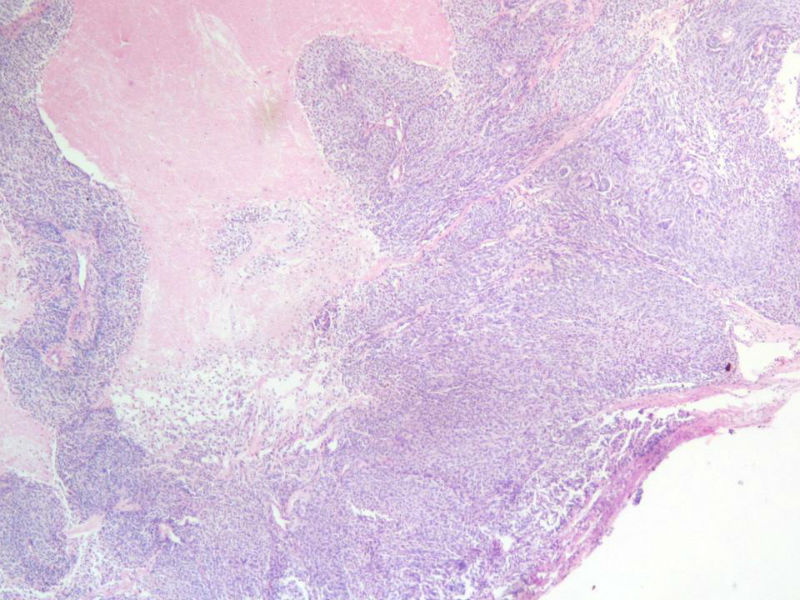 脑左颞部占位图3