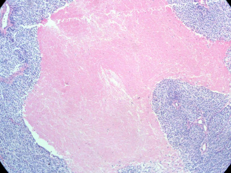 脑左颞部占位图4