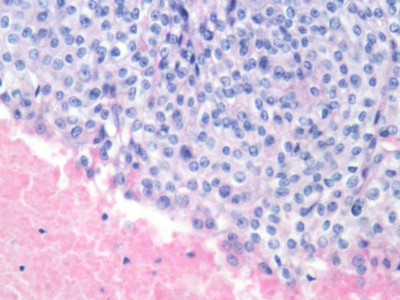 脑左颞部占位图5