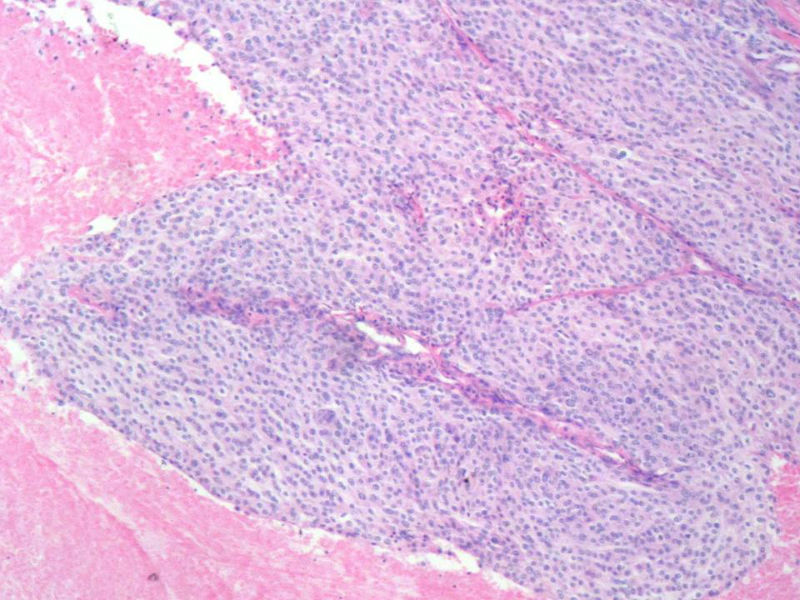 脑左颞部占位图6