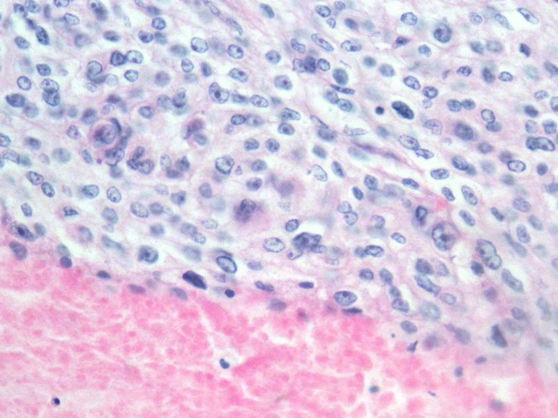 脑左颞部占位图7