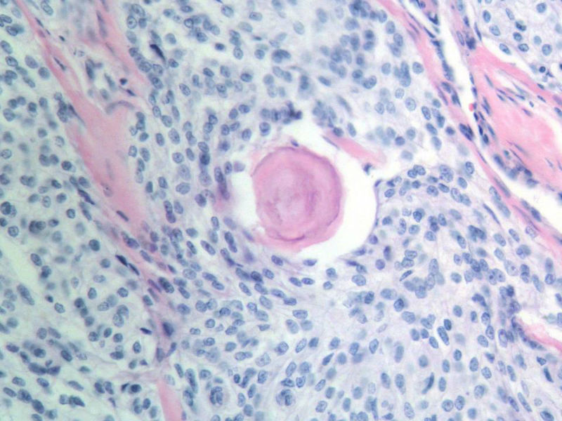 脑左颞部占位图8