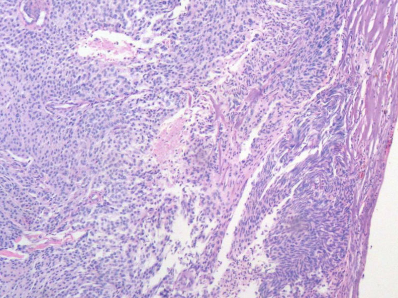 脑左颞部占位图9