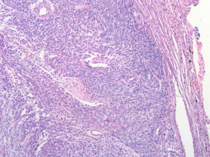 脑左颞部占位图10