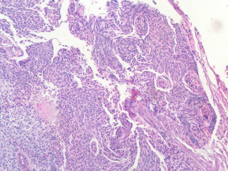 脑左颞部占位图11