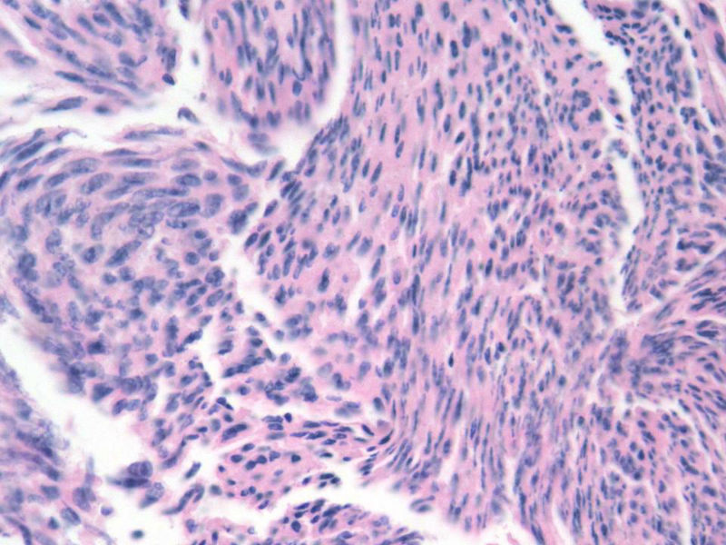 脑左颞部占位图12