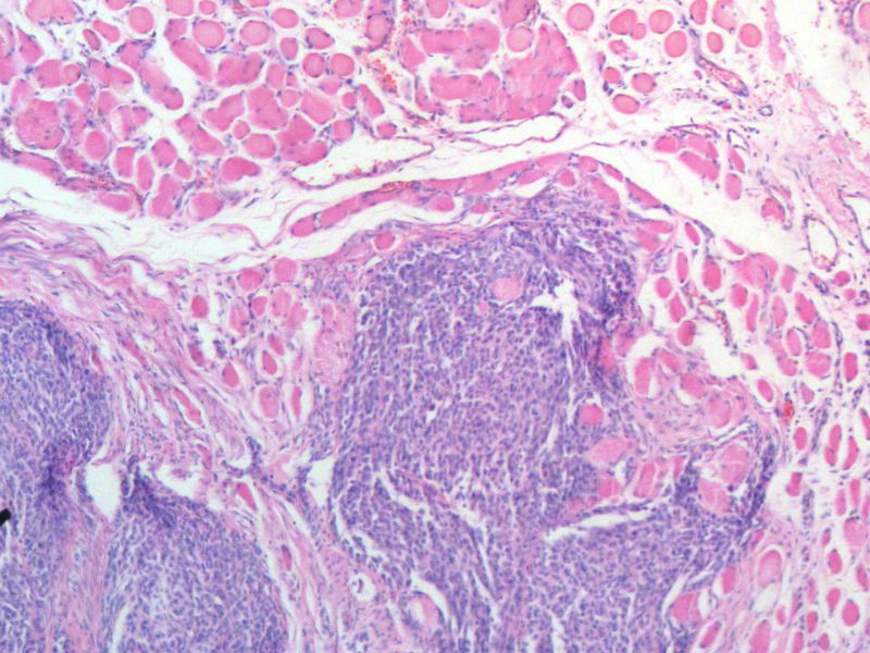 脑左颞部占位图13