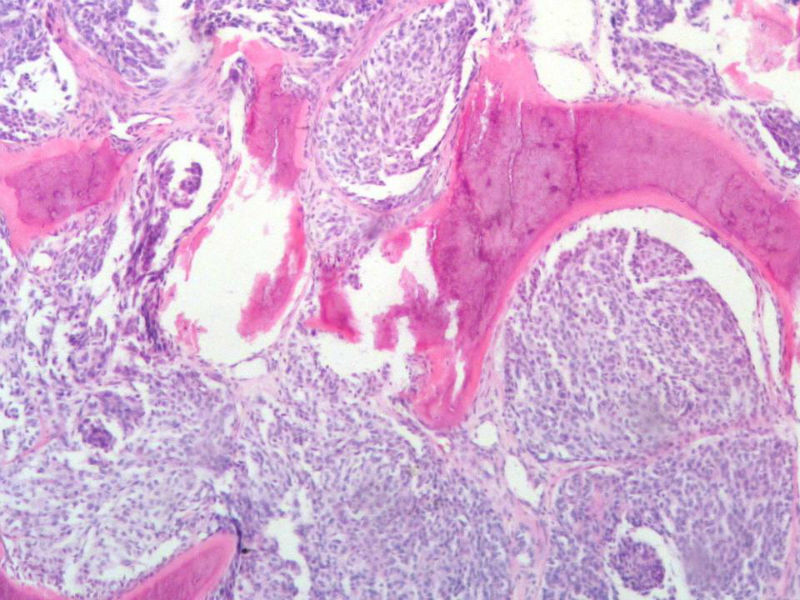 脑左颞部占位图15