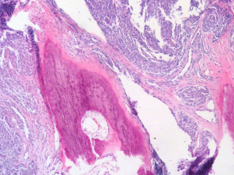 脑左颞部占位图16