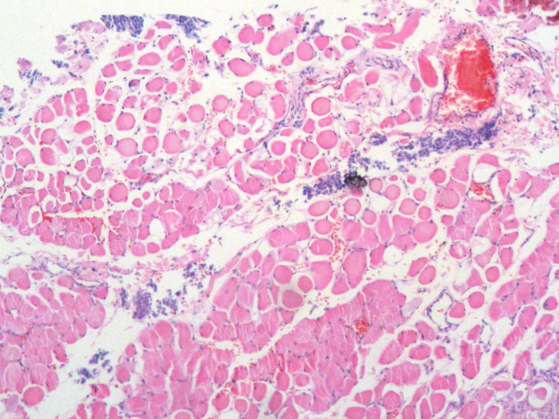 脑左颞部占位图17