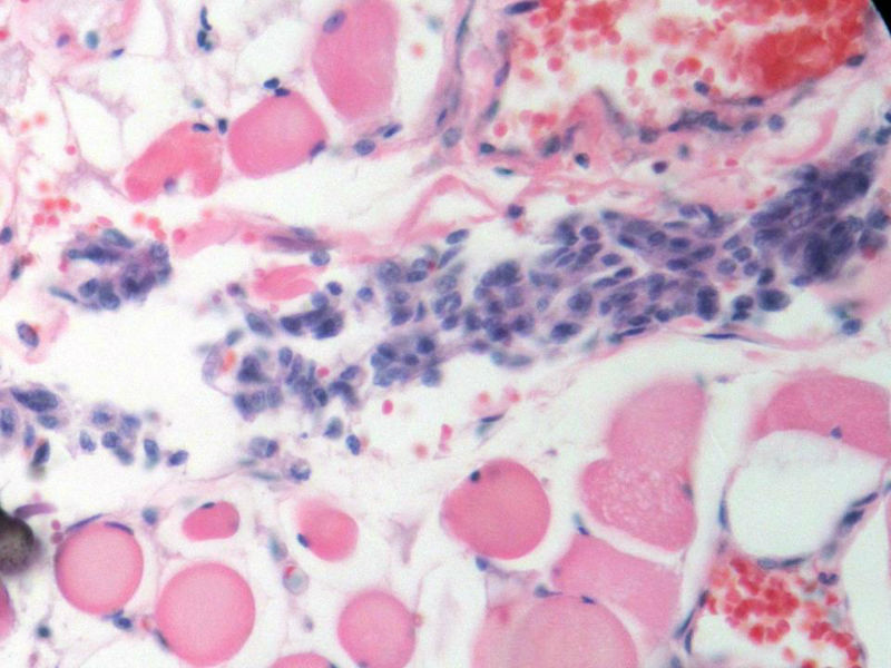 脑左颞部占位图18