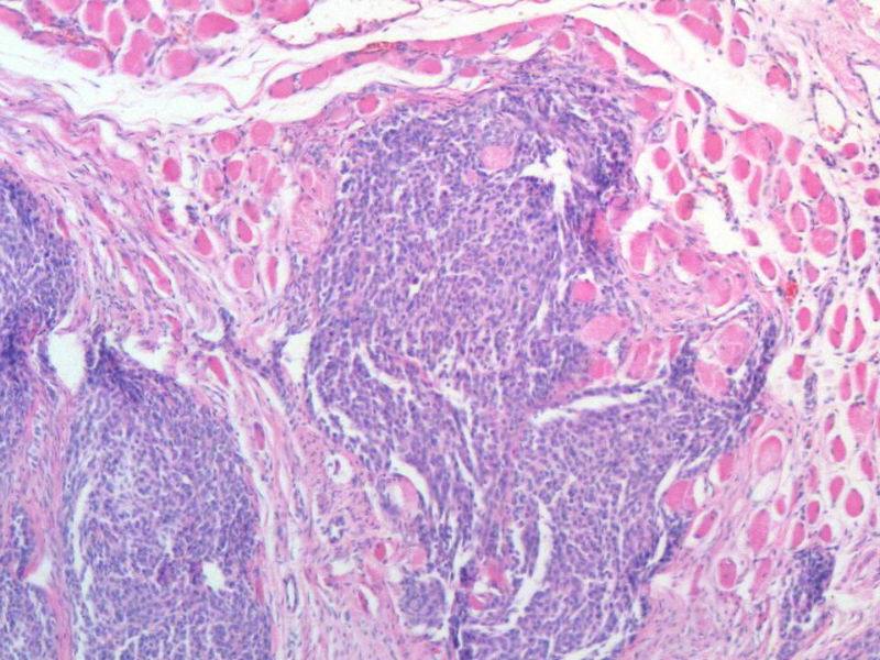 脑左颞部占位图19