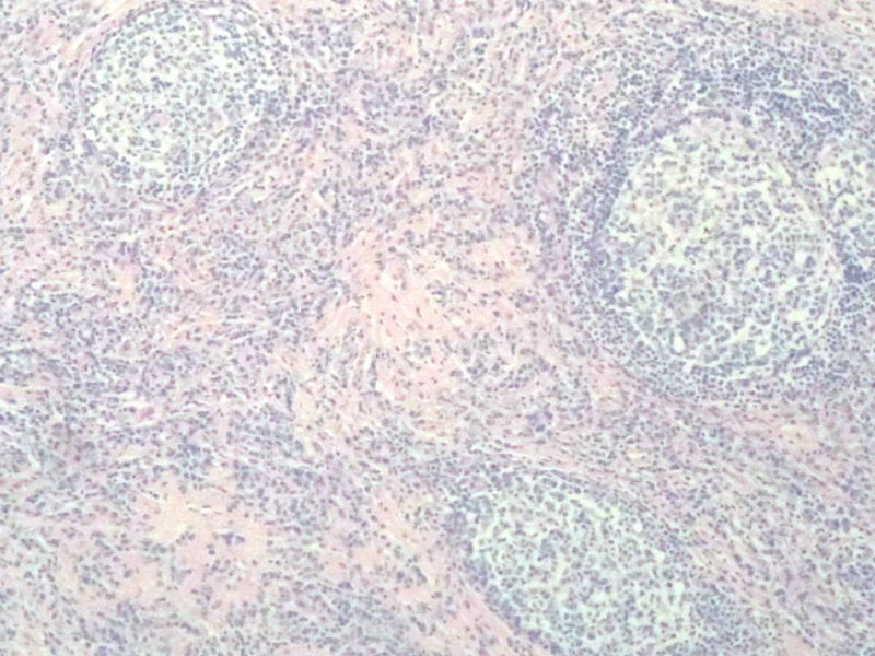 右颌下肿块,新加免疫组化图2 右颌下肿块,新加免疫组化图2