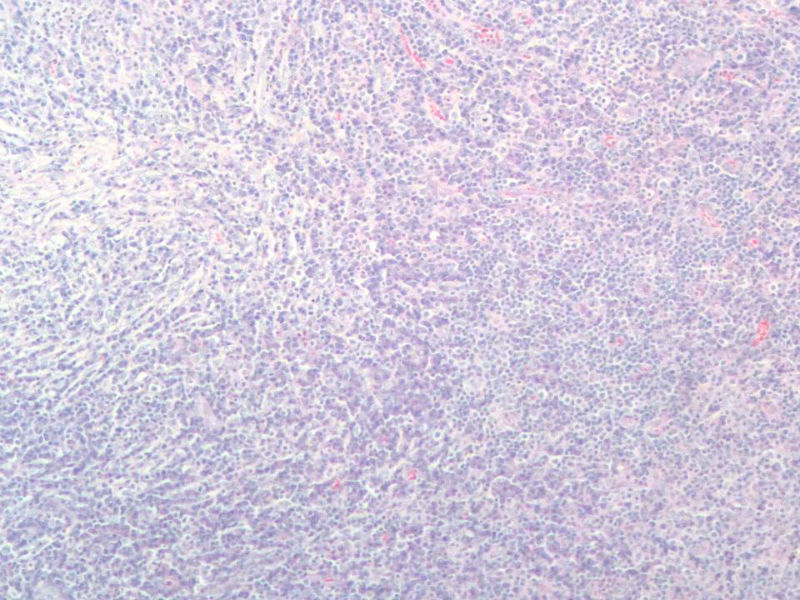 右颌下肿块，新加免疫组化图5