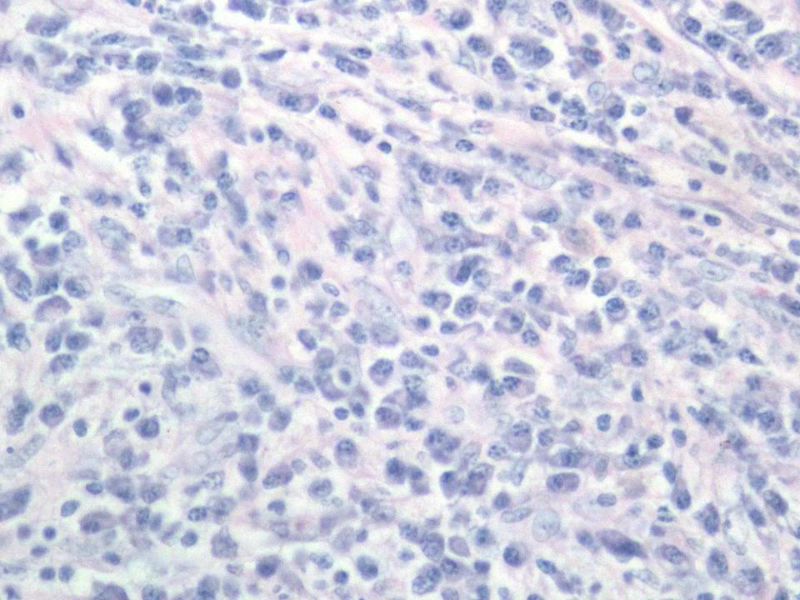 右颌下肿块，新加免疫组化图8