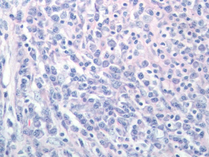 右颌下肿块,新加免疫组化图17 右颌下肿块,新加免疫组化图17