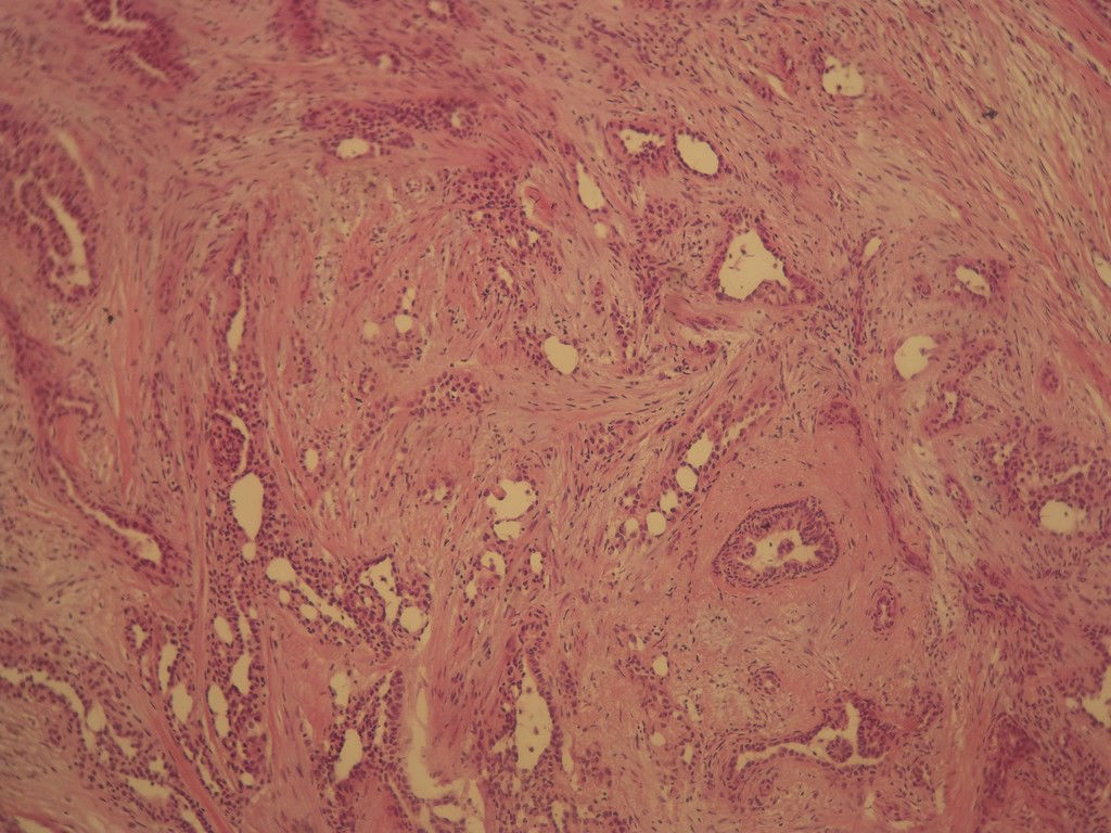 腺病？癌？其他？(12楼常规，24楼免疫组化及会诊结果)图4