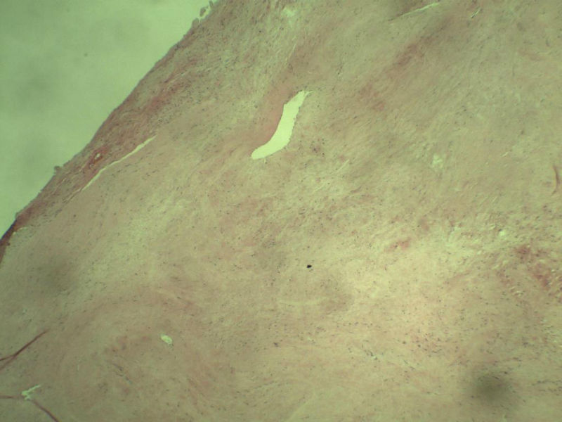 腘窝包块图1 腘窝包块图1