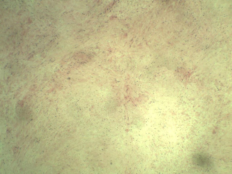 腘窝包块图2 腘窝包块图2