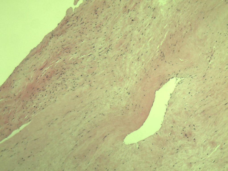 腘窝包块图3 腘窝包块图3