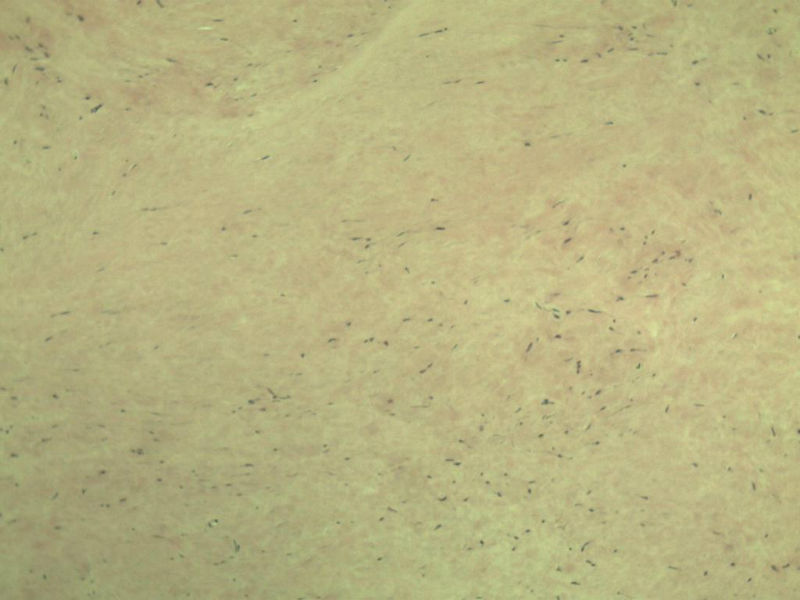 腘窝包块图4 腘窝包块图4