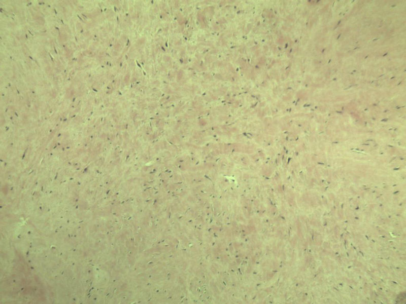 腘窝包块图5 腘窝包块图5