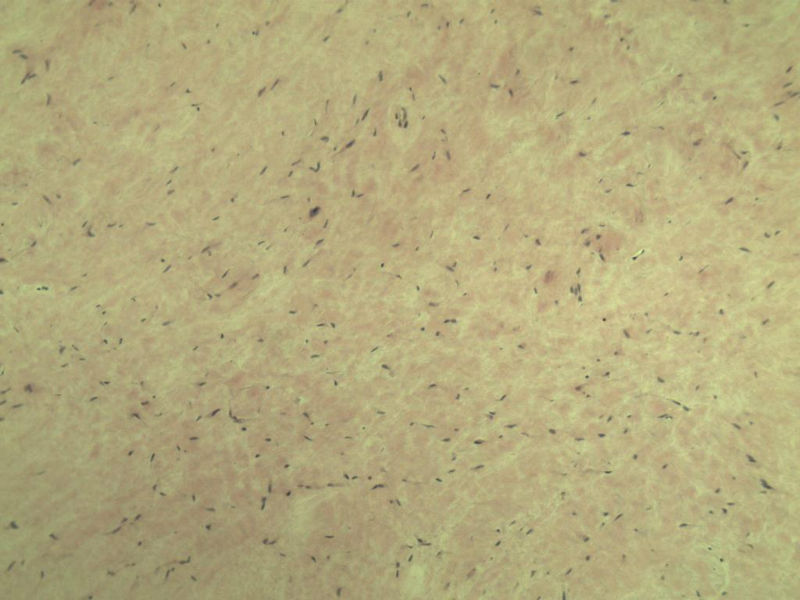 腘窝包块图6 腘窝包块图6