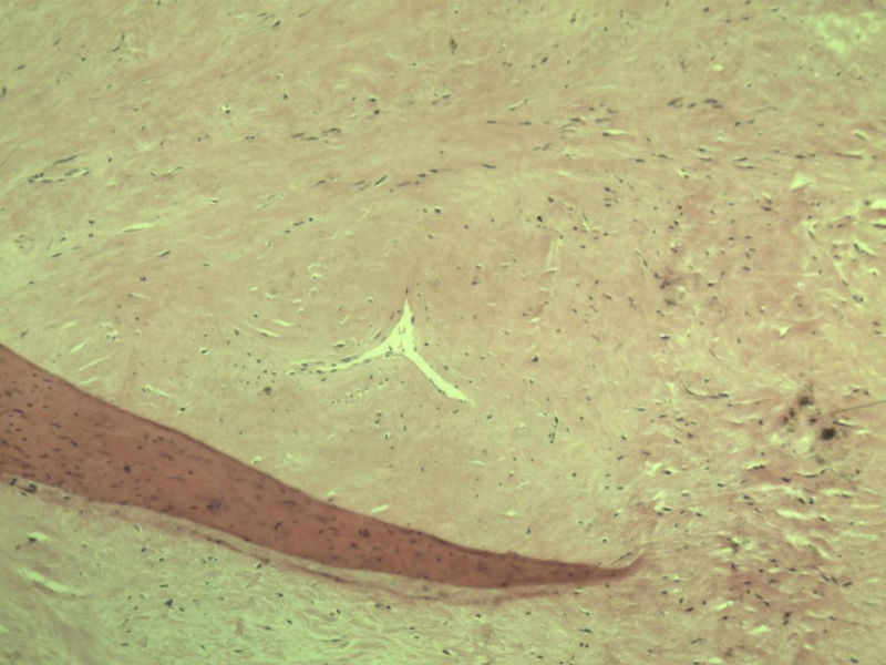 腘窝包块图7 腘窝包块图7