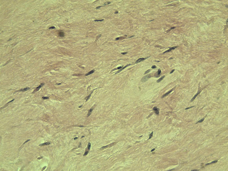 腘窝包块图8 腘窝包块图8