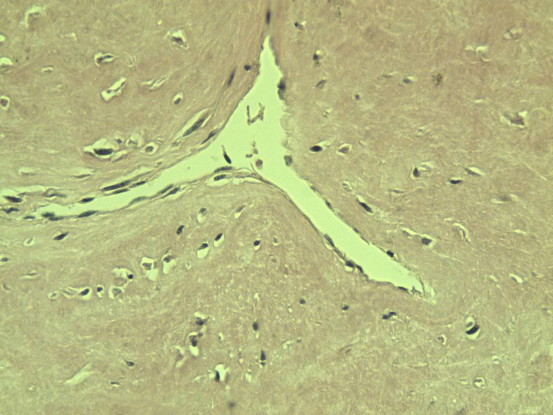 腘窝包块图9 腘窝包块图9