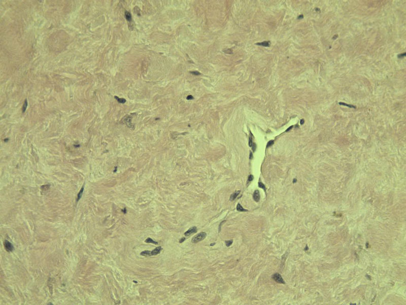 腘窝包块图10 腘窝包块图10