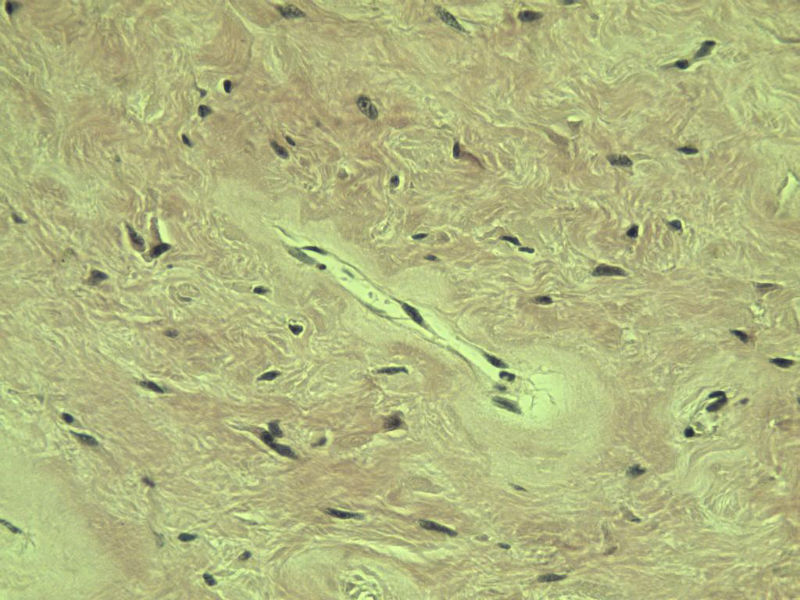 腘窝包块图11 腘窝包块图11